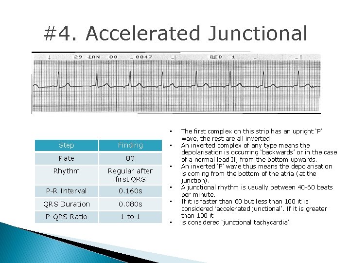#4. Accelerated Junctional • Step Finding Rate 80 Rhythm Regular after first QRS P-R #4. Accelerated Junctional • Step Finding Rate 80 Rhythm Regular after first QRS P-R