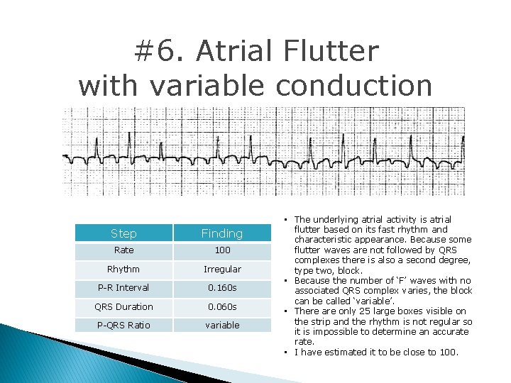 #6. Atrial Flutter with variable conduction Step Finding Rate 100 Rhythm Irregular P-R Interval #6. Atrial Flutter with variable conduction Step Finding Rate 100 Rhythm Irregular P-R Interval