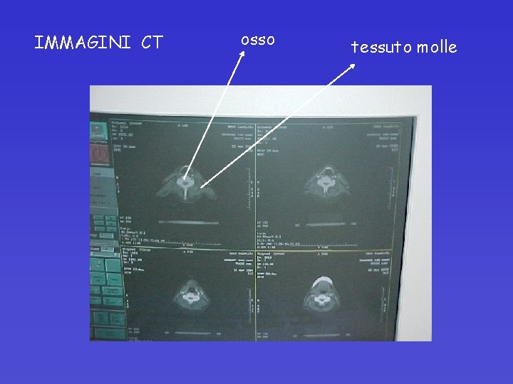 IMMAGINI CT osso tessuto molle 