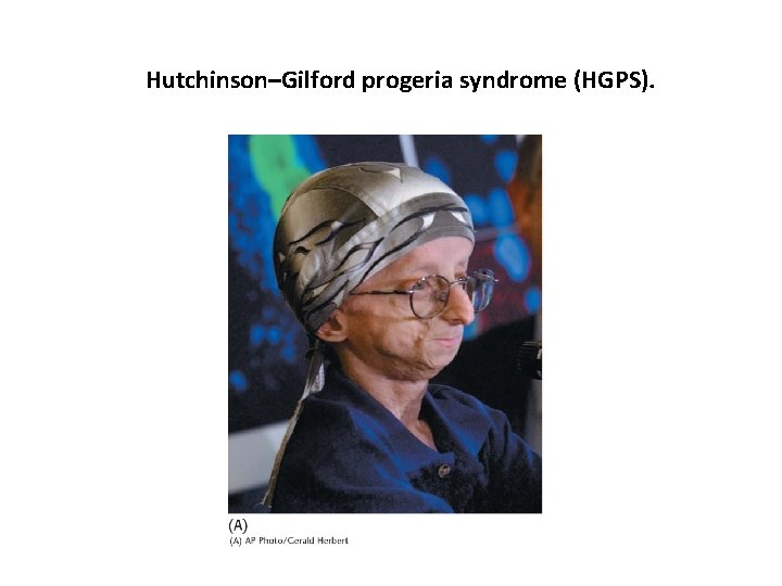 Hutchinson–Gilford progeria syndrome (HGPS). 
