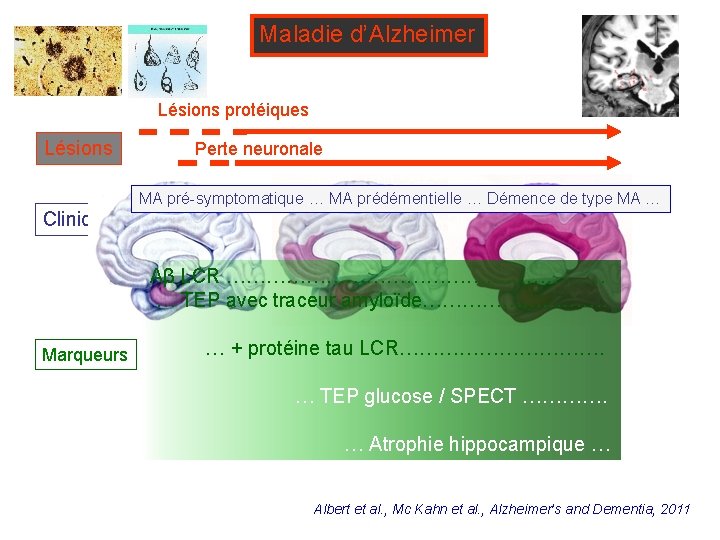 Maladie d’Alzheimer Lésions protéiques Lésions Clinique Perte neuronale MA pré-symptomatique … MA prédémentielle …