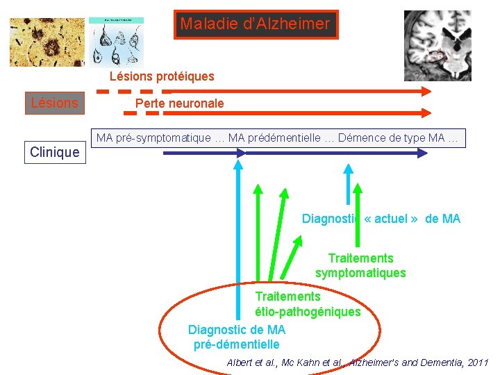 Maladie d’Alzheimer Lésions protéiques Lésions Clinique Perte neuronale MA pré-symptomatique … MA prédémentielle …