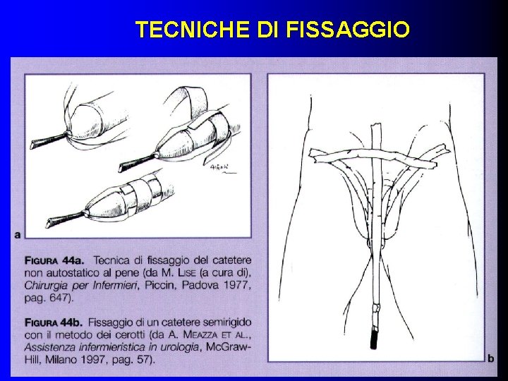 TECNICHE DI FISSAGGIO 