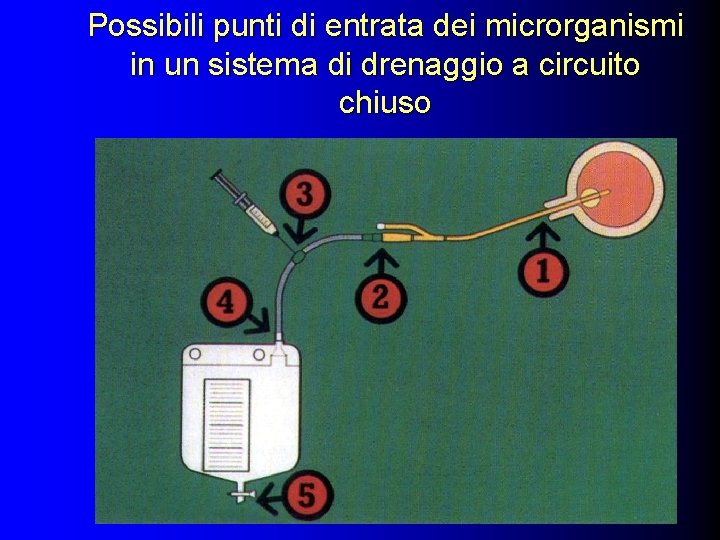 Possibili punti di entrata dei microrganismi in un sistema di drenaggio a circuito chiuso