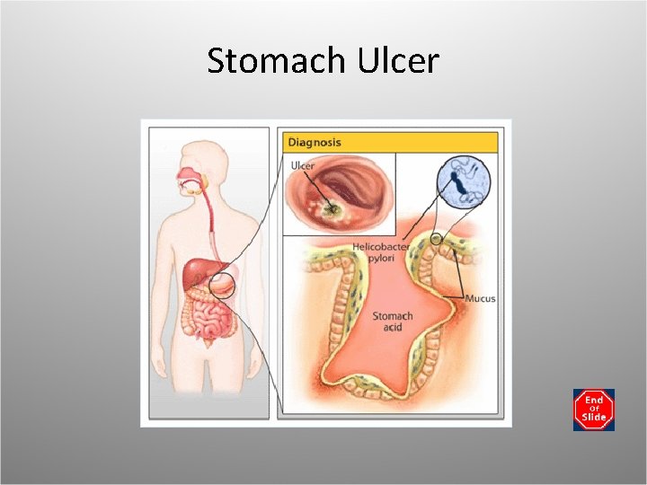 Stomach Ulcer 