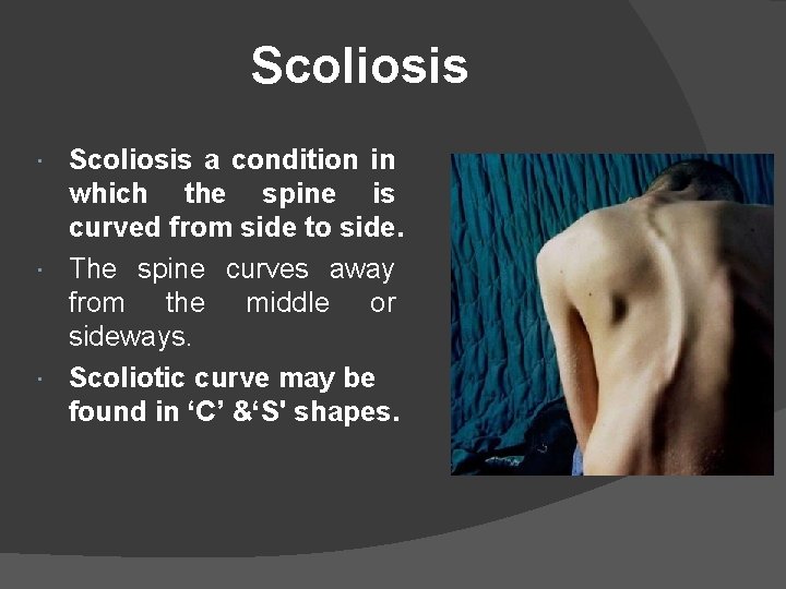 Scoliosis a condition in which the spine is curved from side to side. The