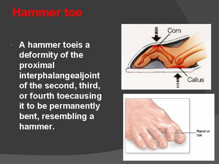 Hammer toe A hammer toeis a deformity of the proximal interphalangealjoint of the second,