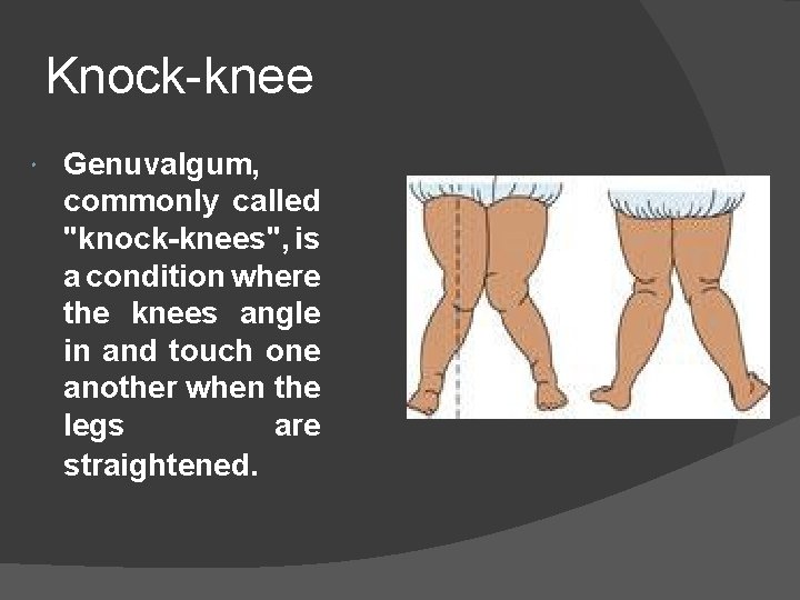 Knock-knee Genuvalgum, commonly called "knock-knees", is a condition where the knees angle in and