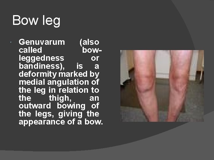 Bow leg Genuvarum (also called bowleggedness or bandiness), is a deformity marked by medial