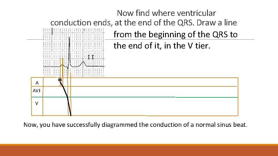 Now find where ventricular conduction ends, at the end of the QRS. Draw a