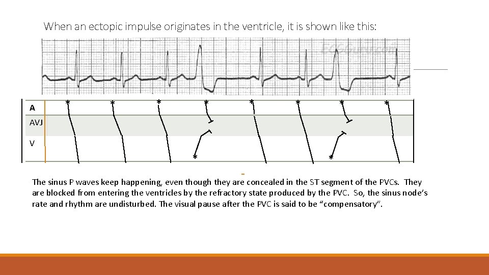 When an ectopic impulse originates in the ventricle, it is shown like this: A