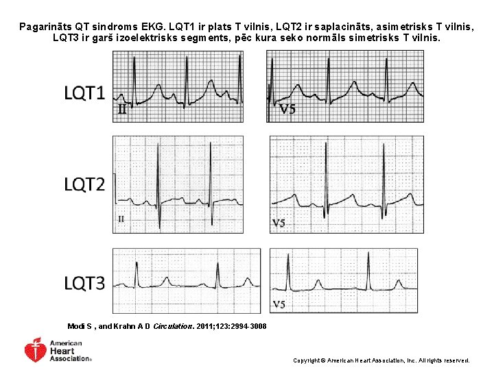 Pagarināts QT sindroms EKG. LQT 1 ir plats T vilnis, LQT 2 ir saplacināts,