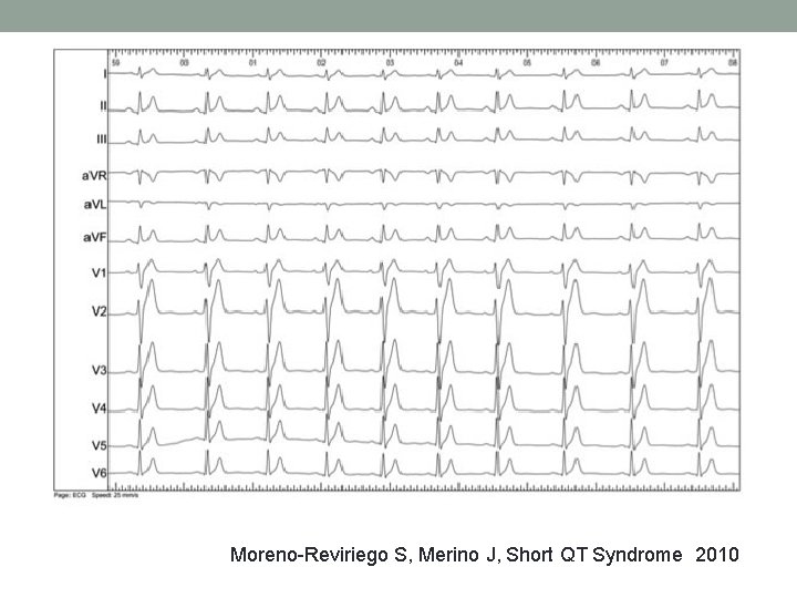 Moreno-Reviriego S, Merino J, Short QT Syndrome 2010 