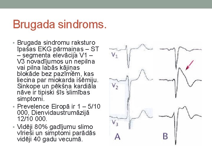 Brugada sindroms. • Brugada sindromu raksturo īpašas EKG pārmaiņas – ST – segmenta elevācija