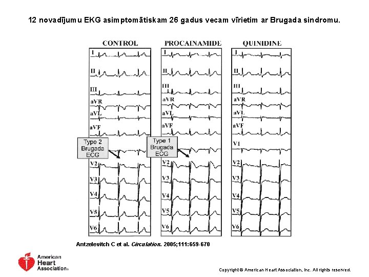 12 novadījumu EKG asimptomātiskam 26 gadus vecam vīrietim ar Brugada sindromu. Antzelevitch C et