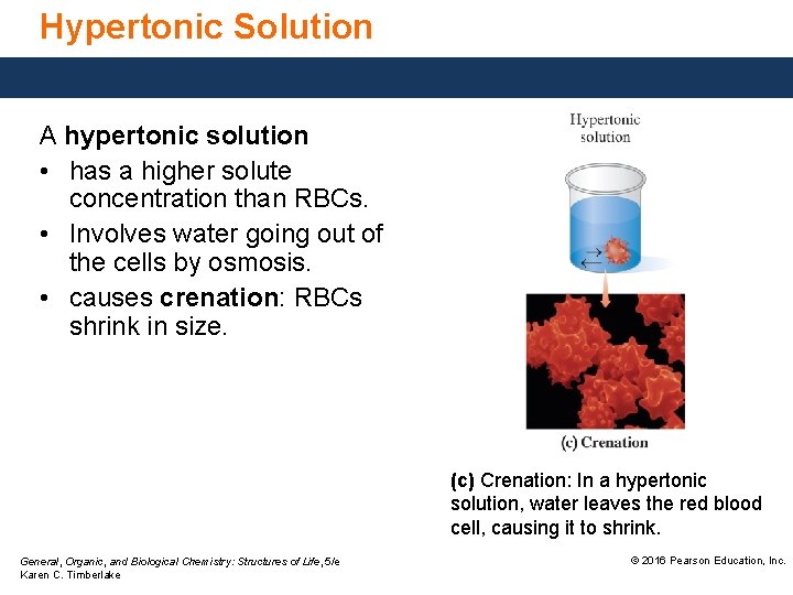Hypertonic Solution A hypertonic solution • has a higher solute concentration than RBCs. •