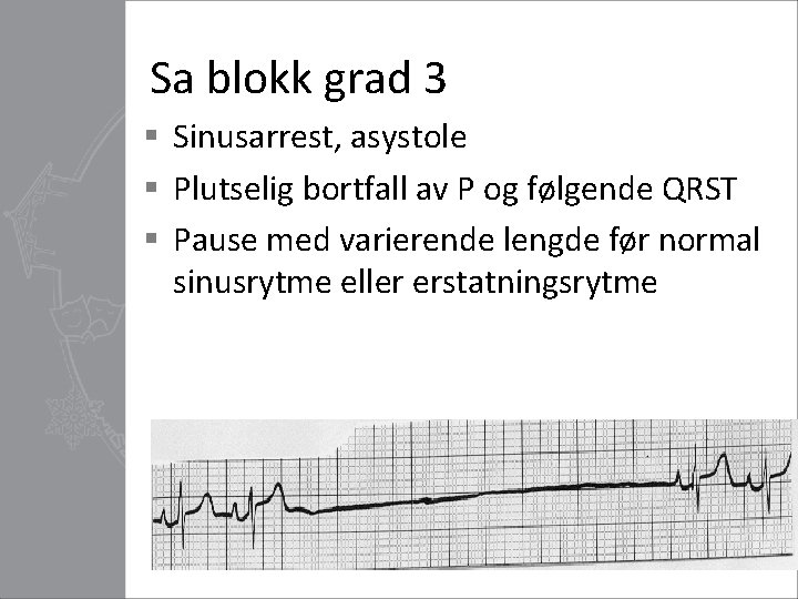 Sa blokk grad 3 § Sinusarrest, asystole § Plutselig bortfall av P og følgende
