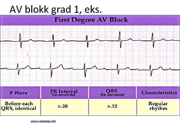 AV blokk grad 1, eks. John C Grammer 1: 43 