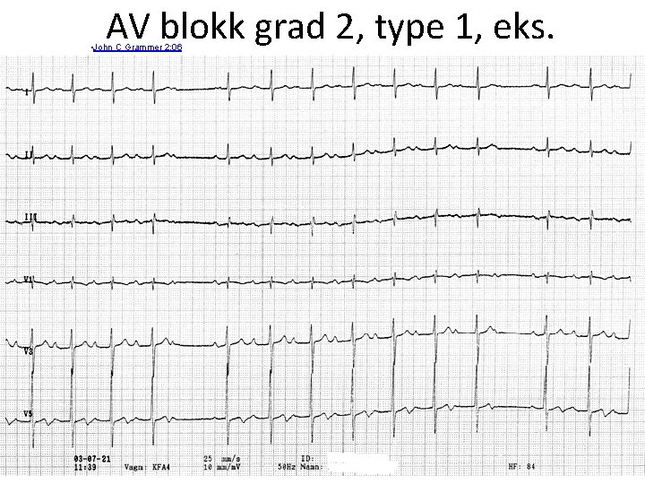 AV blokk grad 2, type 1, eks. • John C Grammer 2: 06 