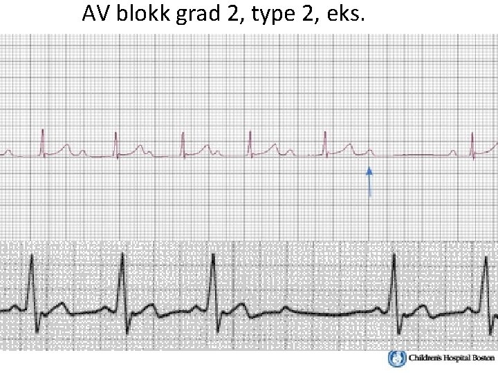 AV blokk grad 2, type 2, eks. 