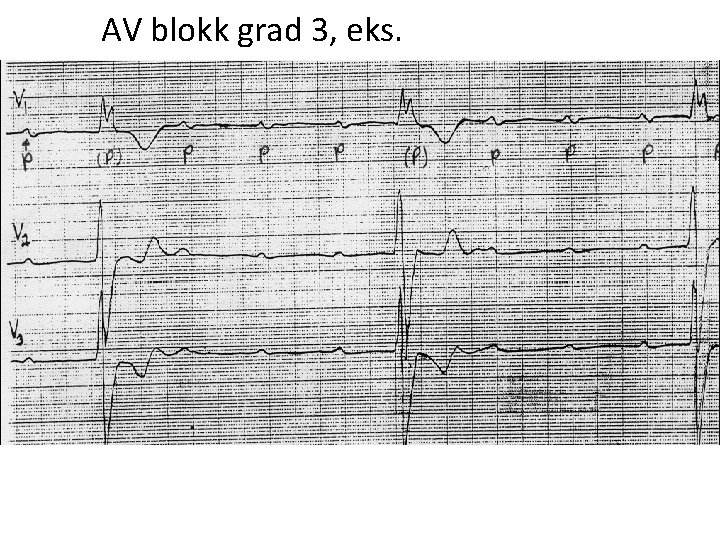 AV blokk grad 3, eks. 