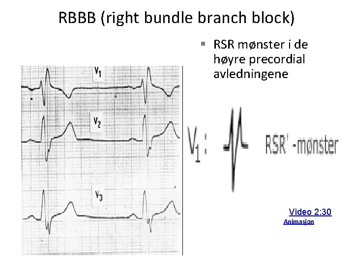 RBBB (right bundle branch block) § RSR mønster i de høyre precordial avledningene Video