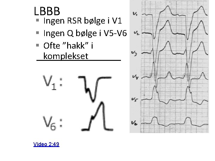 LBBB § Ingen RSR bølge i V 1 § Ingen Q bølge i V