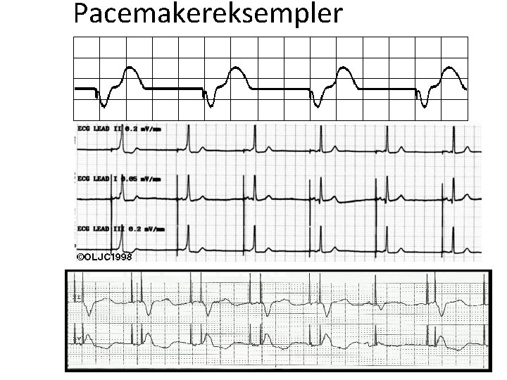 Pacemakereksempler 