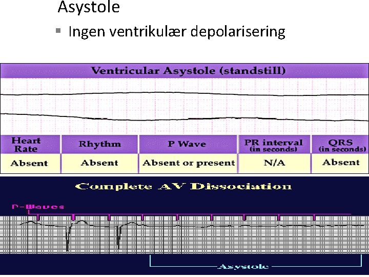 Asystole § Ingen ventrikulær depolarisering 
