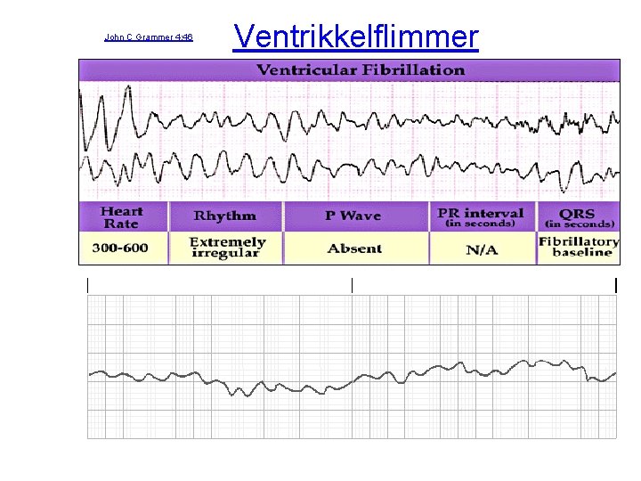 John C Grammer 4: 46 Ventrikkelflimmer 