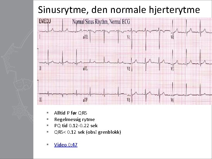 Sinusrytme, den normale hjerterytme § § Alltid P før QRS Regelmessig rytme PQ tid