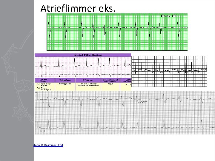 Atrieflimmer eks. John C Grammer 3: 54 