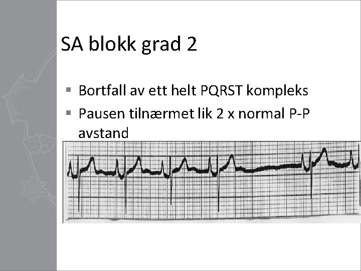 SA blokk grad 2 § Bortfall av ett helt PQRST kompleks § Pausen tilnærmet