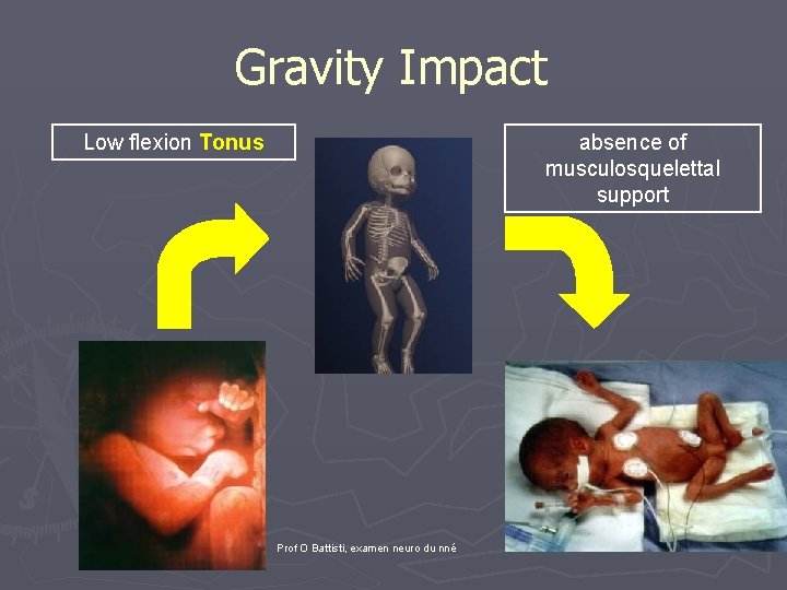  Gravity Impact Low flexion Tonus absence of musculosquelettal support Prof O Battisti, examen