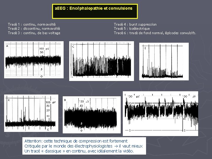 a. EEG : Encéphalopathie et convulsions Tracé 1 : continu, normovolté Tracé 2 :