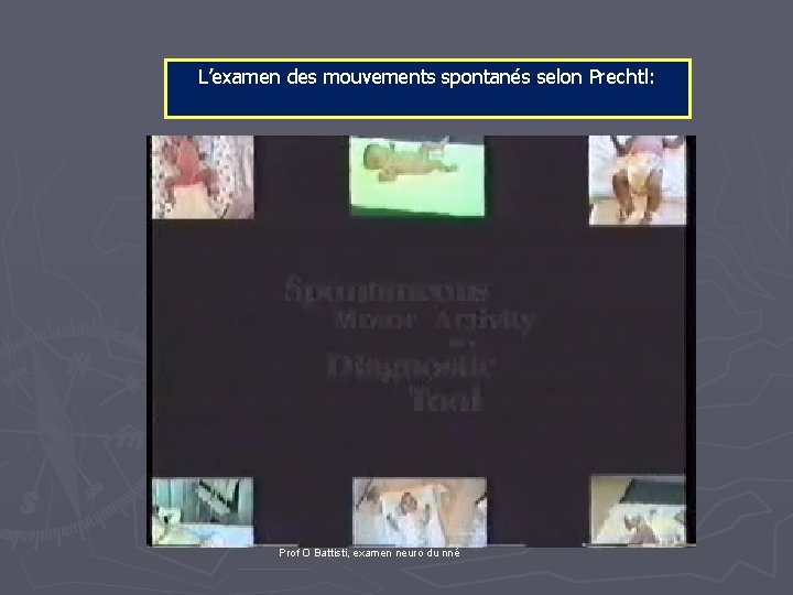  L’examen des mouvements spontanés selon Prechtl: Prof O Battisti, examen neuro du nné
