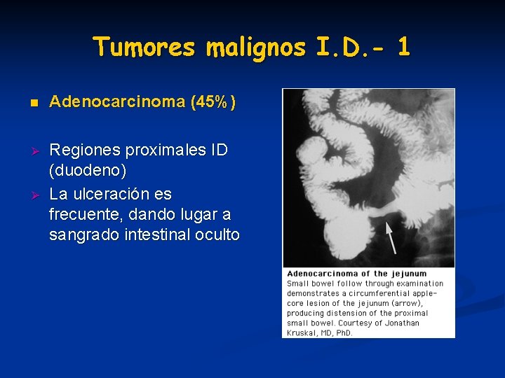 Tumores malignos I. D. - 1 n Adenocarcinoma (45%) Ø Regiones proximales ID (duodeno) Tumores malignos I. D. - 1 n Adenocarcinoma (45%) Ø Regiones proximales ID (duodeno)