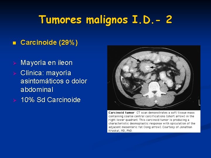 Tumores malignos I. D. - 2 n Carcinoide (29%) Ø Mayoría en ileon Clínica: Tumores malignos I. D. - 2 n Carcinoide (29%) Ø Mayoría en ileon Clínica: