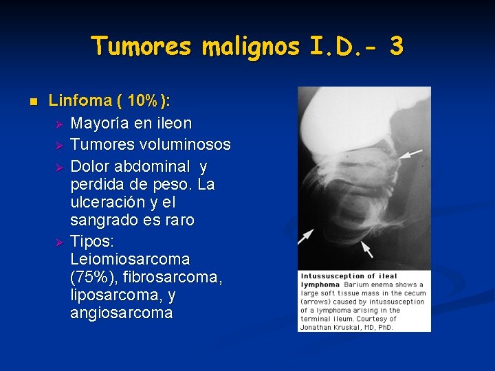Tumores malignos I. D. - 3 n Linfoma ( 10%): Ø Mayoría en ileon Tumores malignos I. D. - 3 n Linfoma ( 10%): Ø Mayoría en ileon
