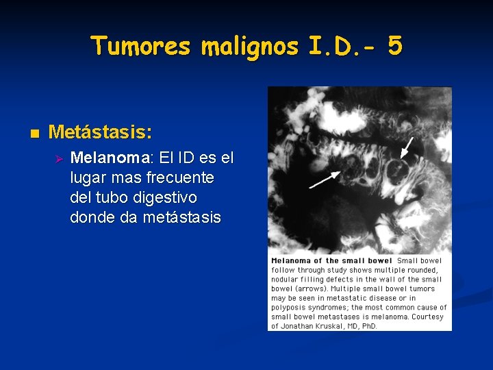 Tumores malignos I. D. - 5 n Metástasis: Ø Melanoma: El ID es el Tumores malignos I. D. - 5 n Metástasis: Ø Melanoma: El ID es el