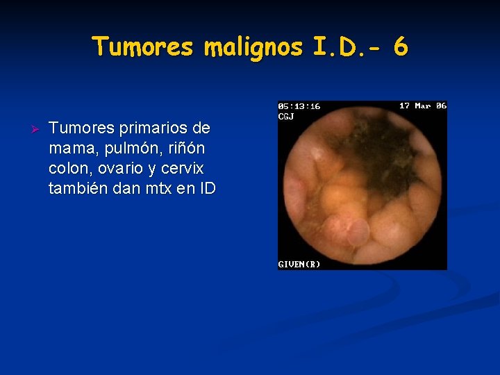 Tumores malignos I. D. - 6 Ø Tumores primarios de mama, pulmón, riñón colon, Tumores malignos I. D. - 6 Ø Tumores primarios de mama, pulmón, riñón colon,