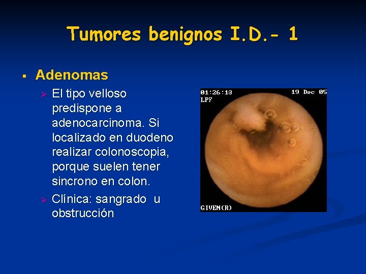 Tumores benignos I. D. - 1 § Adenomas Ø Ø El tipo velloso predispone Tumores benignos I. D. - 1 § Adenomas Ø Ø El tipo velloso predispone