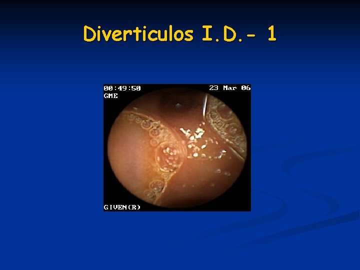 Diverticulos I. D. - 1 Diverticulos I. D. - 1