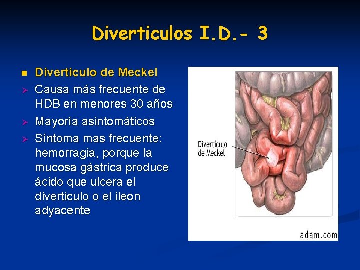 Diverticulos I. D. - 3 n Ø Ø Ø Diverticulo de Meckel Causa más Diverticulos I. D. - 3 n Ø Ø Ø Diverticulo de Meckel Causa más