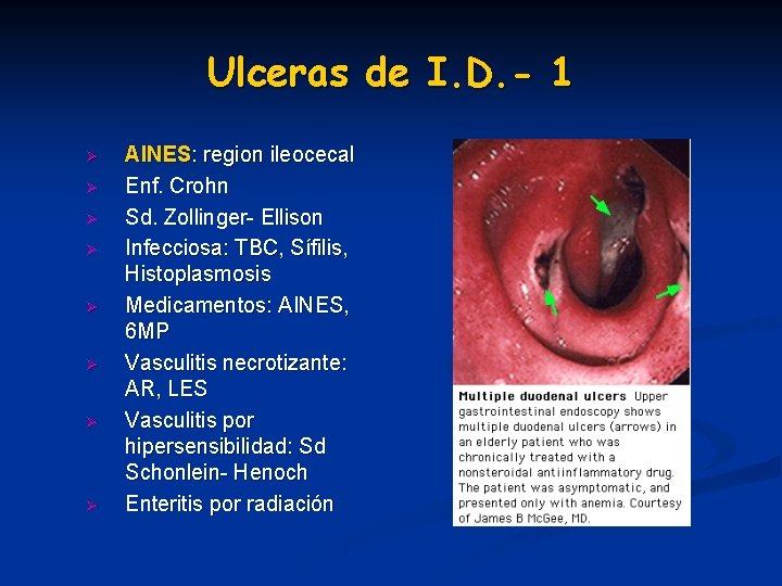 Ulceras de I. D. - 1 Ø Ø Ø Ø AINES: region ileocecal Enf. Ulceras de I. D. - 1 Ø Ø Ø Ø AINES: region ileocecal Enf.