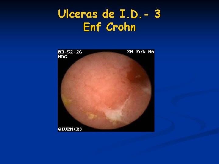 Ulceras de I. D. - 3 Enf Crohn Ulceras de I. D. - 3 Enf Crohn