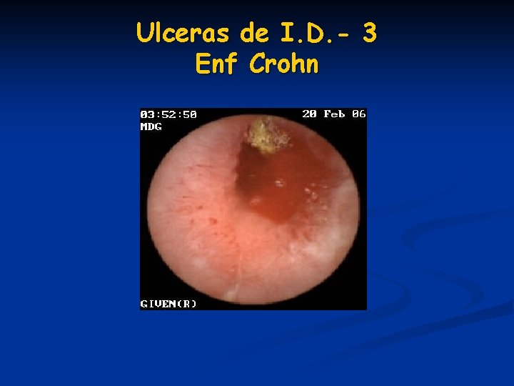 Ulceras de I. D. - 3 Enf Crohn Ulceras de I. D. - 3 Enf Crohn