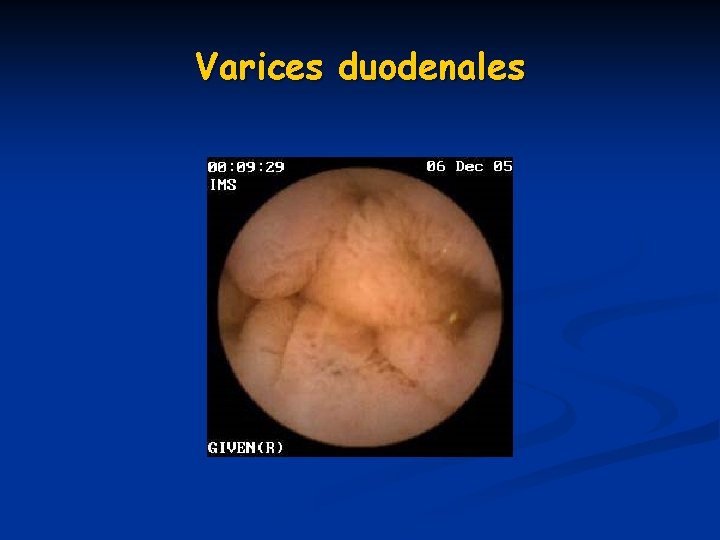 Varices duodenales Varices duodenales
