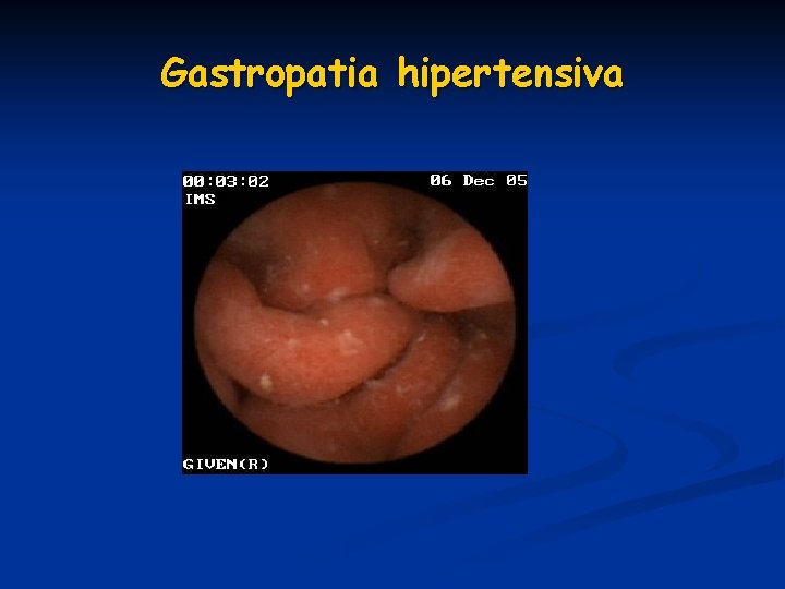 Gastropatia hipertensiva Gastropatia hipertensiva