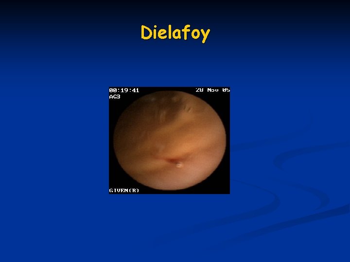 Dielafoy Dielafoy